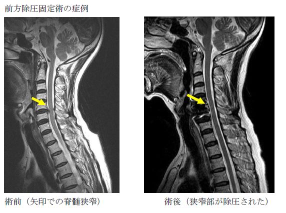 脊椎・脊髄 - 脊椎変性疾患